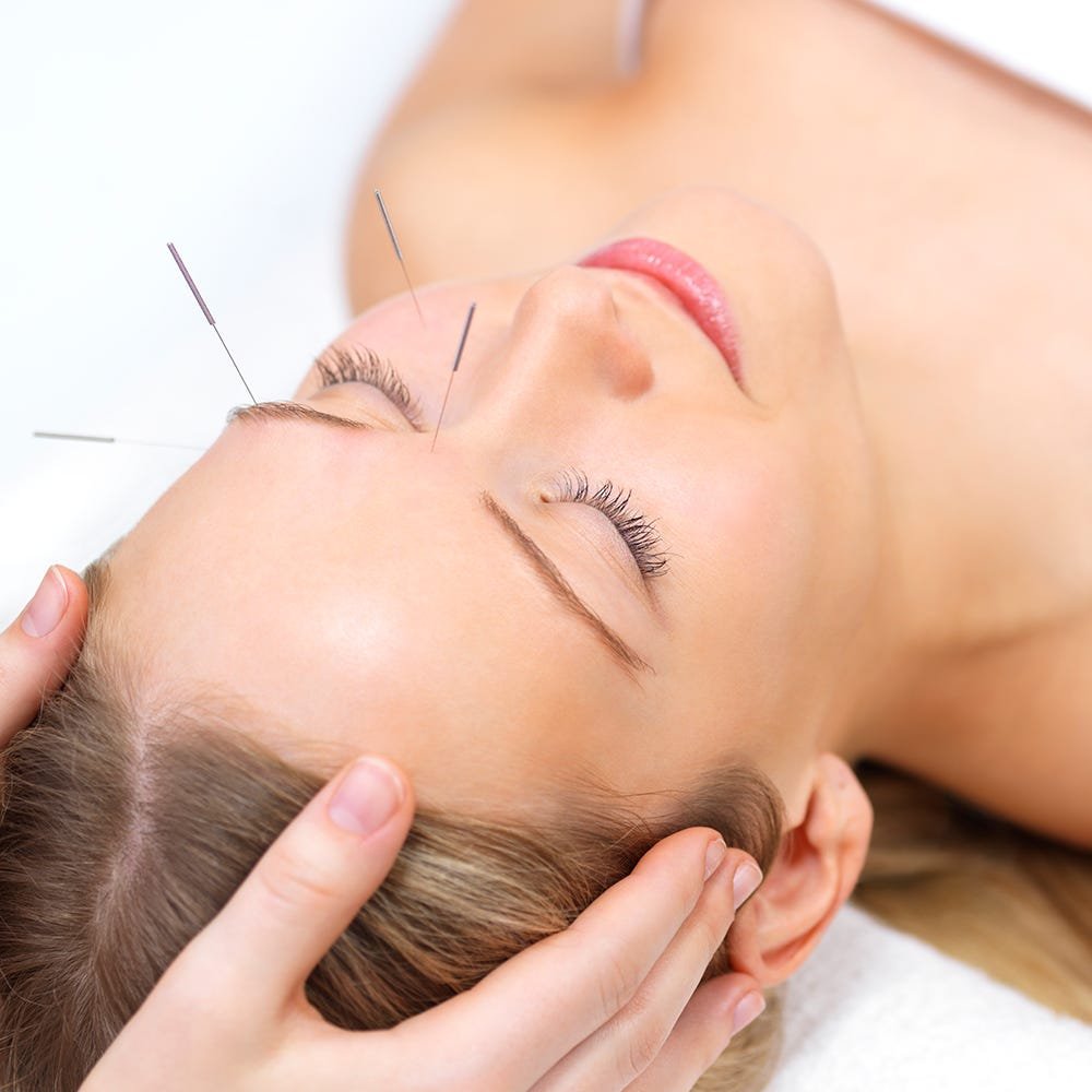 Lifting facial con acupuntura